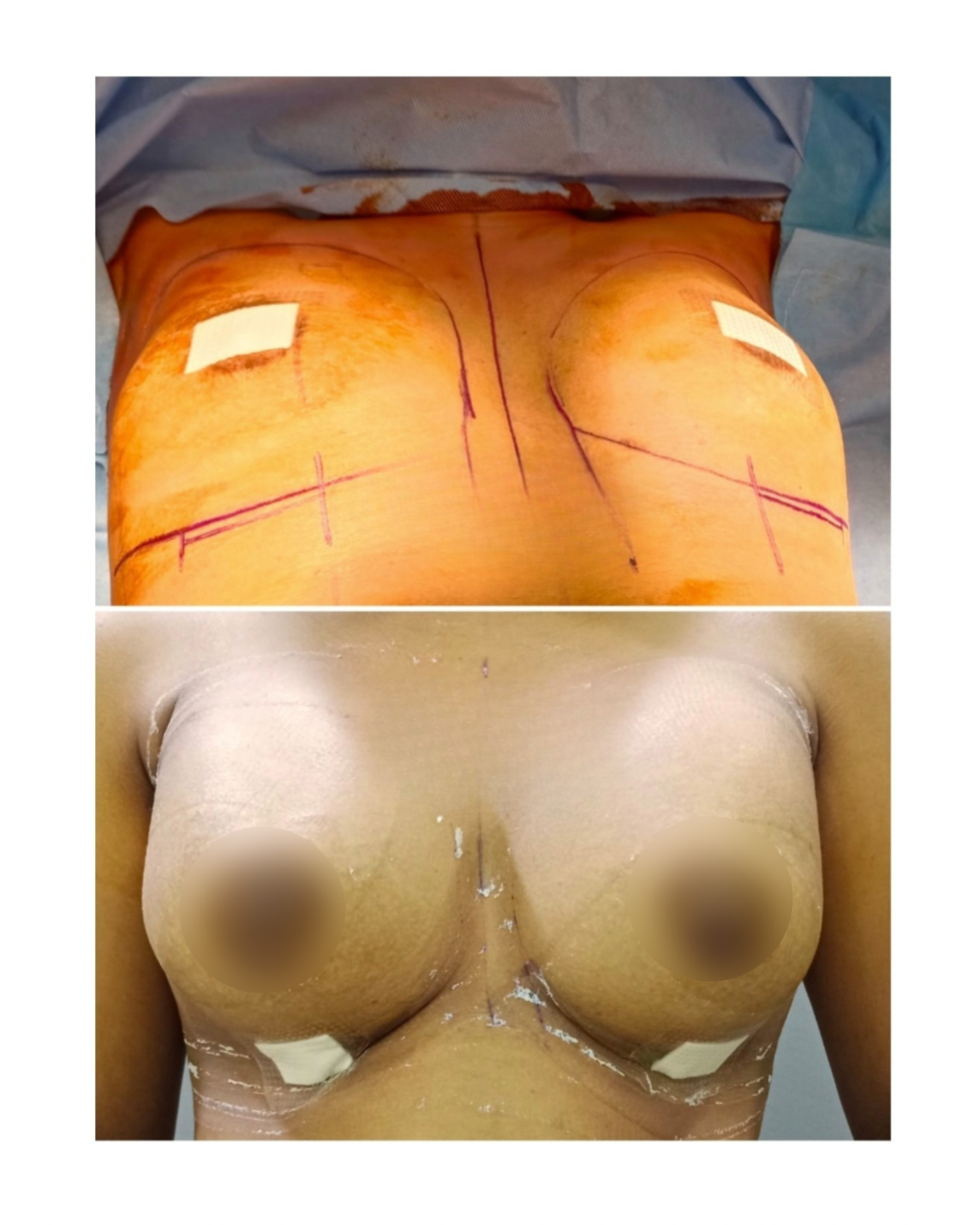 Breast Augmentation Clinical Frontal View