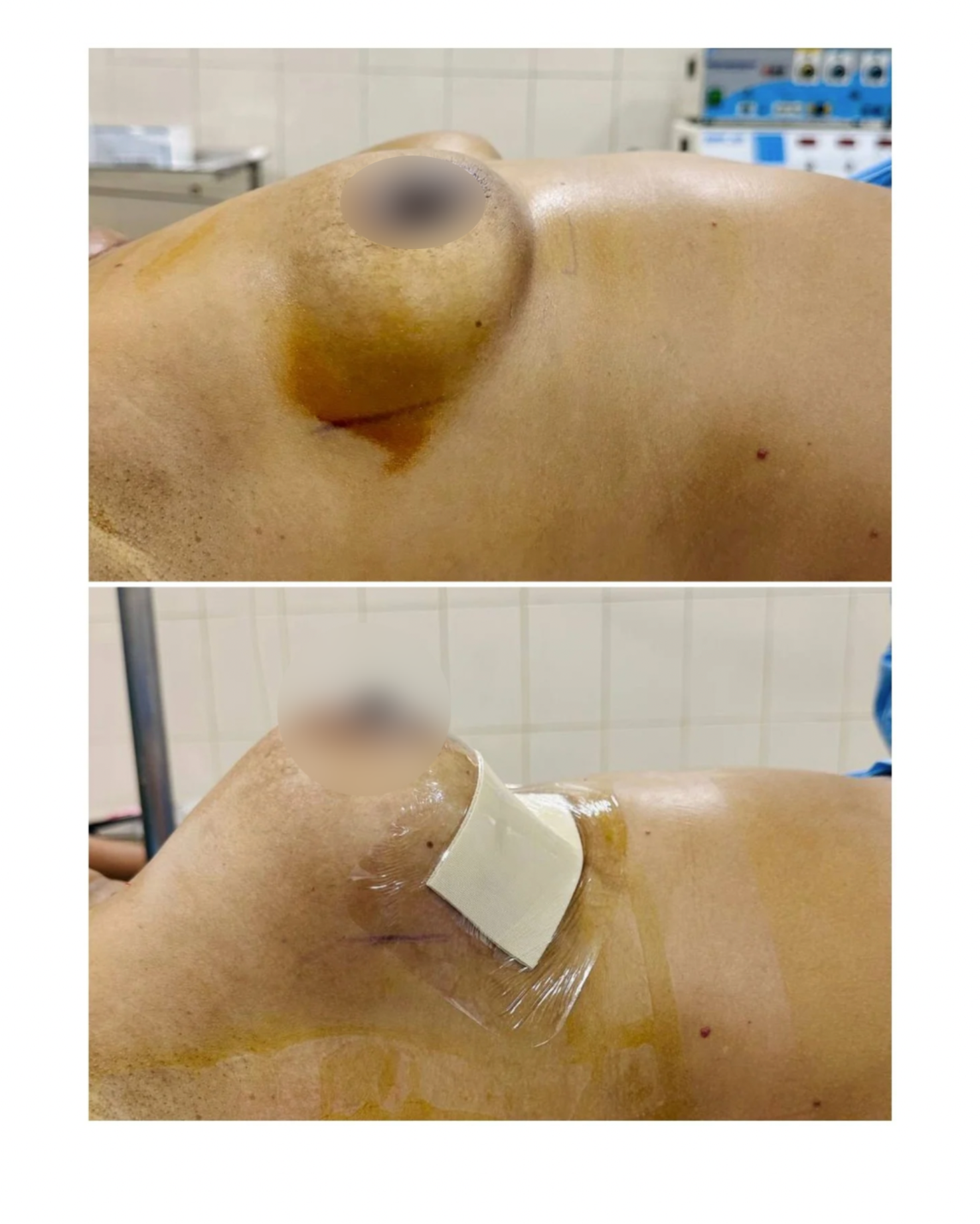 Breast Augmentation Clinical Lateral View
