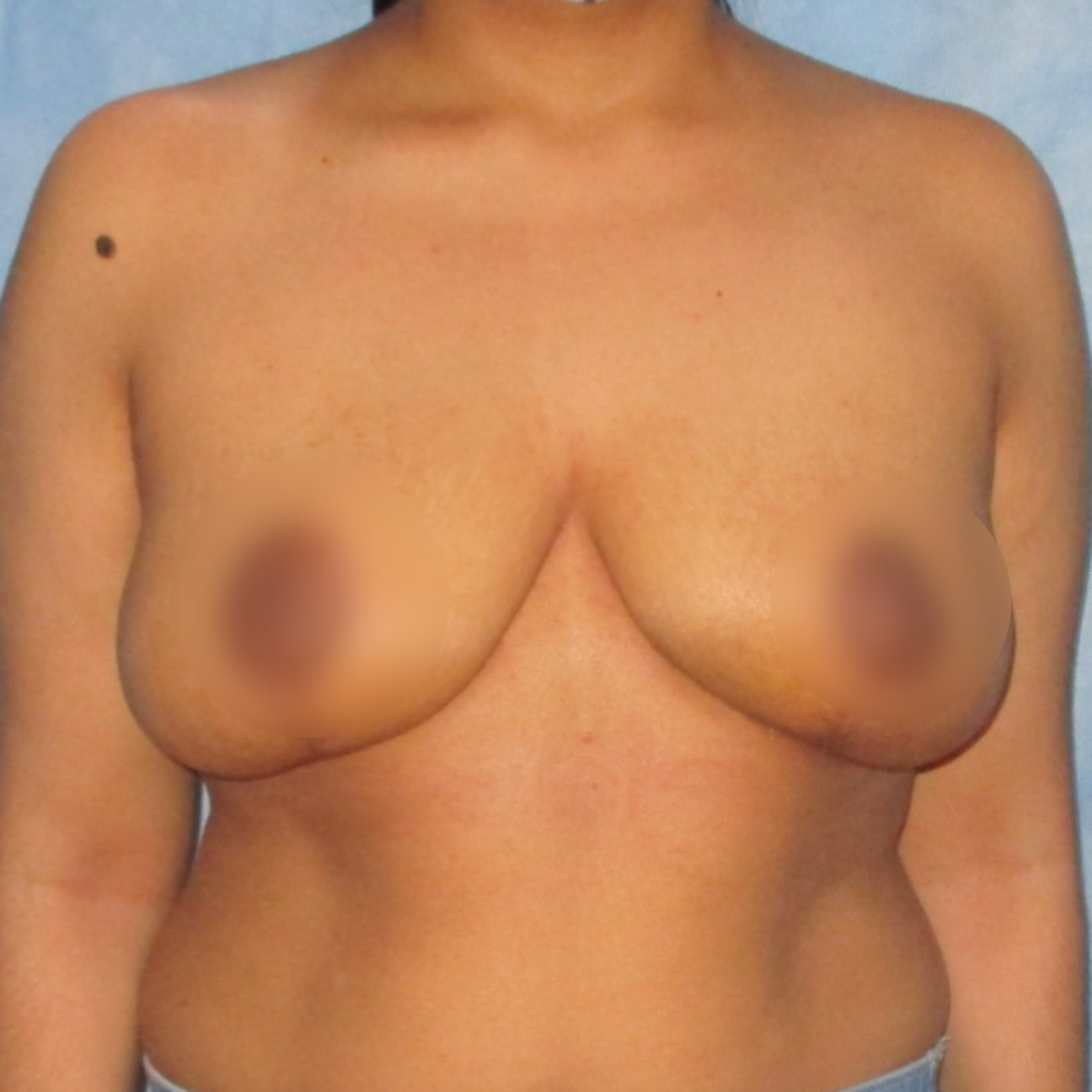Breast Reduction Post-Operative Outcome