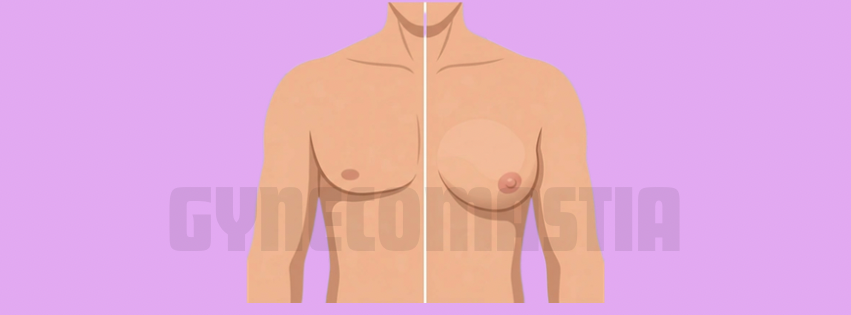 Gynecomastia (Man Boobs) - Dr. Nanthini Aesthetic & Reconstructive Surgery