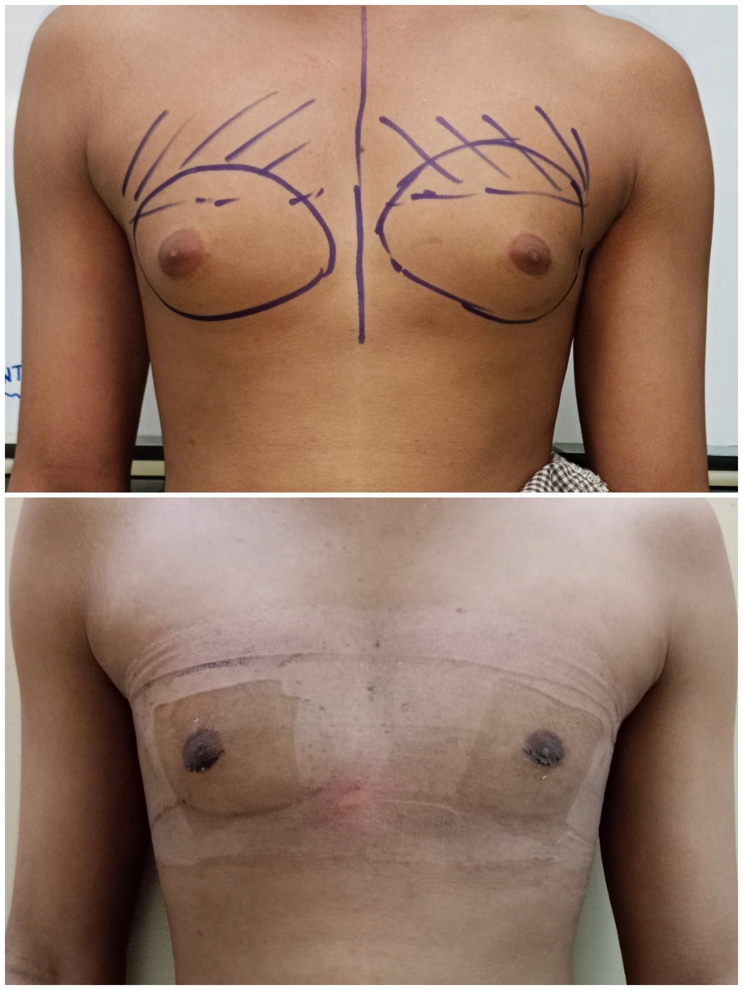 GRADE 1 GYNECOMASTIA