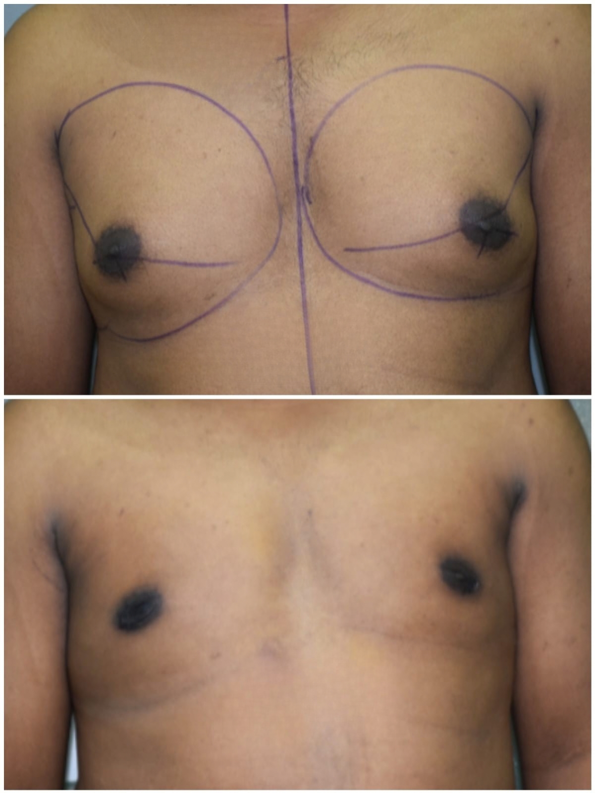 GRADE 2 GYNECOMASTIA Case 1