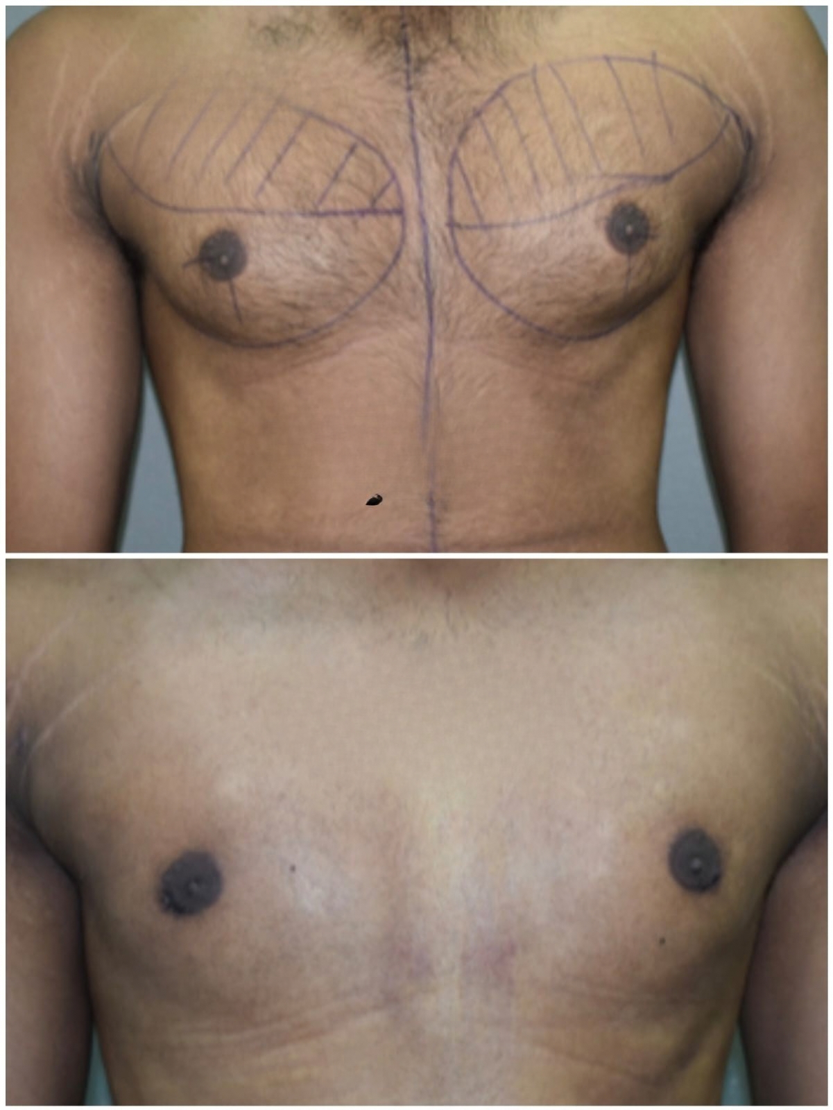 GRADE 2 GYNECOMASTIA Case 2