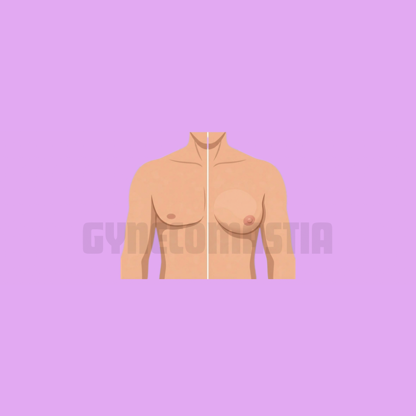 Gynecomastia Male Chest Contouring